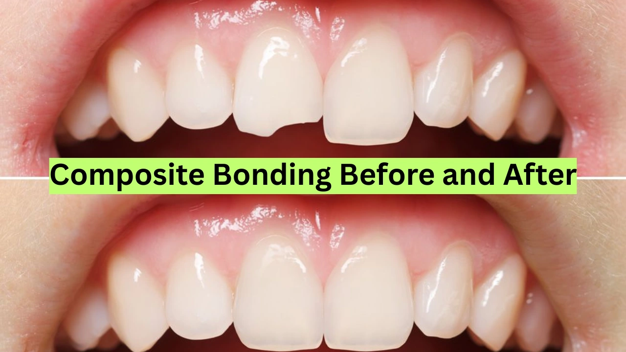 Composite Bonding Before and After