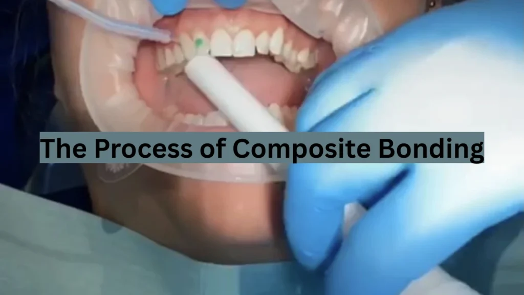 The Process of Composite Bonding